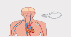Bild zeigt ein implantierbarer Kardioverter Defibrillator und eine Grafik, wo dieser im Körper implantiert wird.